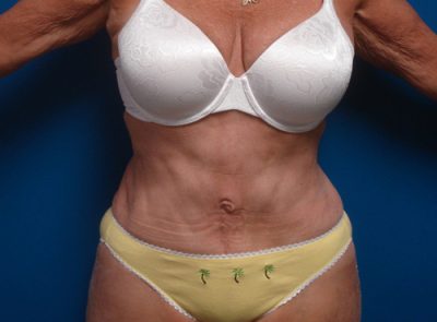 Abdominoplasty