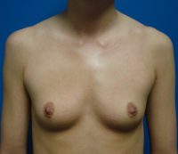 Breast Augmentation Before & After Photos