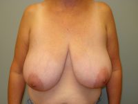 Breast Reduction Before & After Photos