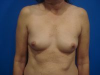 Breast Augmentation Before & After Photos