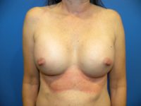 Breast Augmentation Before & After Photos