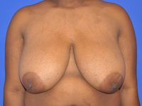 Breast Reduction Before & After Photos