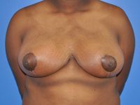 Breast Reduction Before & After Photos