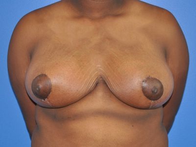 Breast Reduction Before & After Photos
