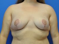 Breast Reduction Before & After Photos