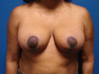 Breast Reduction Before & After Photos