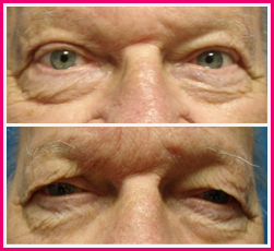 Eyelid Surgery Before and After