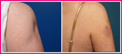 Fat Grafting Before and After