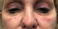 Tear Trough Filler