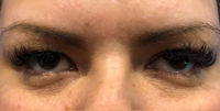 Tear Trough Filler