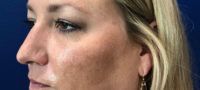 Tear Trough Filler