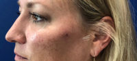 Tear Trough Filler