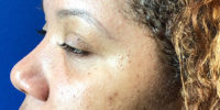 Tear Trough Filler