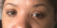 Tear Trough Filler
