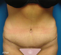 Abdominoplasty