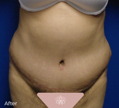 Abdominoplasty