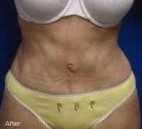 Abdominoplasty