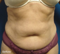 Abdominoplasty
