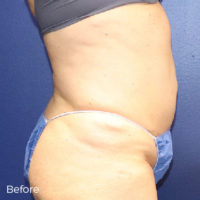 Abdominoplasty