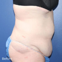 Abdominoplasty