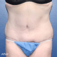 Abdominoplasty